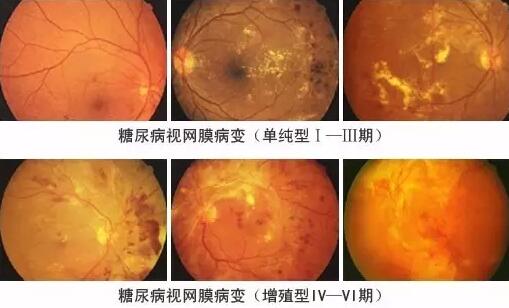 糖尿病引起的眼部并发症有很多，糖尿病视网膜病变(DR)就是其中之一，糖尿病视网膜病变是糖尿病在眼部的一种严重并发症，它对视力有很大危害，如不及时医治，可能造成失明。症状包括视力模糊、阴影、斑点及疼痛。.jpg