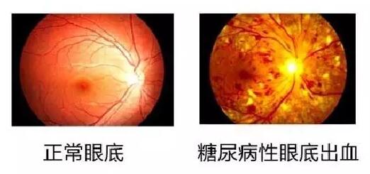  数据表明：糖尿病视网膜病变(简称糖网病)患病率达44%~51.3%，被世界卫生组织认为是仅次于白内障、青光眼的 三致盲眼病。但是不少尤其是基层糖尿病患者，大多数把眼睛的异变误认为是老年人眼花正常现象，从而耽误了病情甚至导致失明。.jpg