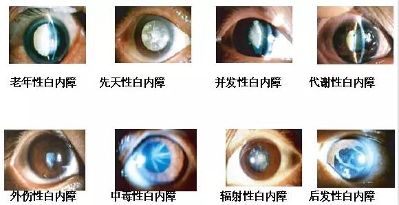 长时间在白色光亮污染环境下工作和生活的人，尤其是长时间接触过强的光线，视网膜和虹膜都会受到程度不同的损害，较终也会伤害晶状体，时间一长，就会使视力下降，使晶状体蛋白发生变性，形成混浊，发展成为白内障1.jpg