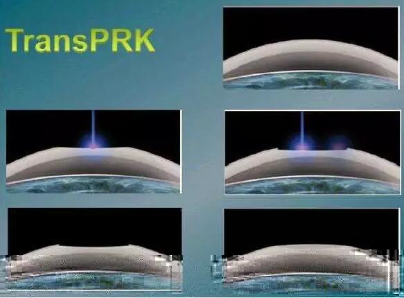 全激光TransPRK手术有其无可比拟的优势，但是 一的缺点就是属于表层手术，术后三天需要配戴隐形眼镜等待上皮愈合，在术后当天以及术后早期眼部会有较飞秒较重的不适感， 时间稍慢，一般需要一周到十天才能逐渐 .jpg