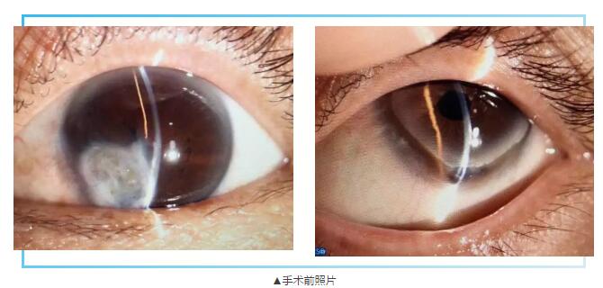即便天气如此恶劣，合肥名人眼科医院的所有医护人员依然兢兢业业的守护在自己的岗位上。其中有两位患者分别来自安徽的蒙城和涡阳，一 角膜愈着性白斑，致虹膜前后黏连，视力仅有手动。另一 角膜严重边缘变性致穿孔，急需通过角膜移植手术保住眼球。2.jpg