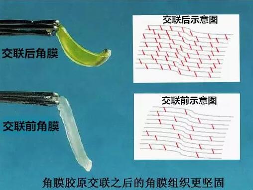 角膜胶原交联(Corneal Cross Linking，CCL)医治：使用370纳米波长的紫外线，激活核黄素(一种光敏感剂)，使其转化成活性氧族，活性氧族再诱导角膜胶原纤维的氨基之间发生化学交联反应，使角膜胶原纤维直径增粗、提*角膜基质对多种降解酶作用的抵抗力等多重生物学效应，从而使角膜基质的机械强度增加2.jpg
