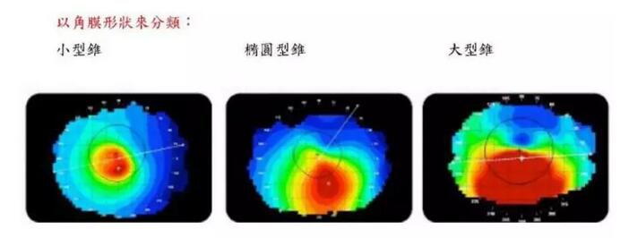 圆锥角膜是一种角膜扩张性疾病，患病后角膜中央或偏中央区域会发生局部变薄向外扩张，导致散光，并随着病情进展逐渐出现视力下降、 不良、视物扭曲变形、虹视等，极大影响生活，严重者可致盲。2.jpg