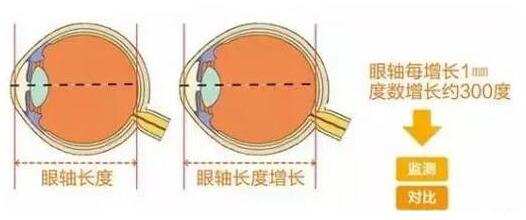 目前主流的摘镜方式有飞秒激光、准分子激光手术、ICL晶体植入术等近视手术方式，不论是高度近视、超高度近视、角膜偏薄患者、干眼患者， 检查合格，都有相应的近视手术 方案。.jpg