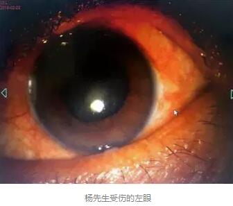 白内障和青光眼都是致盲性眼病，其中青光眼的病程不逆转。杨先生拖延伤情导致同时并发白内障、青光眼的情况，十分令人惋惜。”出名眼科专家、成都8868体育官方网站(官方)登录入口陈晓明教授表示2.jpg