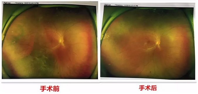 去年小李怀孕时，视力明显下降，甚至影响到了正常生活，这时已从怀孕初期的喜悦中冷静下来的小李，找到了福州眼科医院进行了一*次眼部检查。2.png