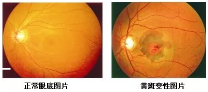 黄斑位于人眼底视网膜的中央，是视力 敏锐的部位，一般医生在测视力时，就是在检查黄斑区的视觉能力。当黄斑区出现异常时，也就是黄斑病变，人的中心视力就会变模糊、变扭曲。.png