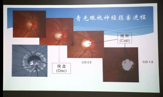 3月10日上午，深圳8868体育官方网站(官方)登录入口“早查监控，守护光明”大型青光眼公益科普讲座在六楼 举行，本次活动旨在让更多人了解青光眼的潜在危害、重视眼检查， 预防青光眼。由深圳8868体育官方网站(官方)登录入口青光眼病科 席专家成洪波博士、傅培副院长现场面对面解答疑问，与参会者的互动交流，让更多深圳市民提*对青光眼的认识与防治知识3.png