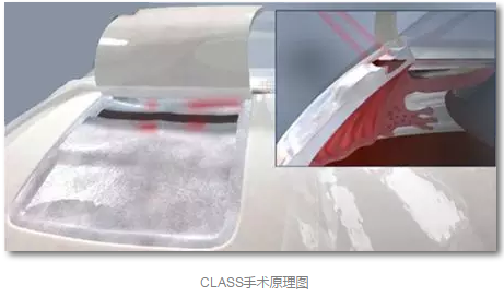 成都8868体育官方网站(官方)登录入口已经开展的青光眼手术有：引流阀 (钉)植入手术(2015年以来已200多 )，360°Schlemm's管切开术，激光CO2 辅助巩膜深层切除术，小梁切除术青(光眼)白(内障)联合手术。还有虹膜周切术、前房成形术、 虹膜复位术，睫状体冷冻术，小梁切开术和前房穿刺术等4.png