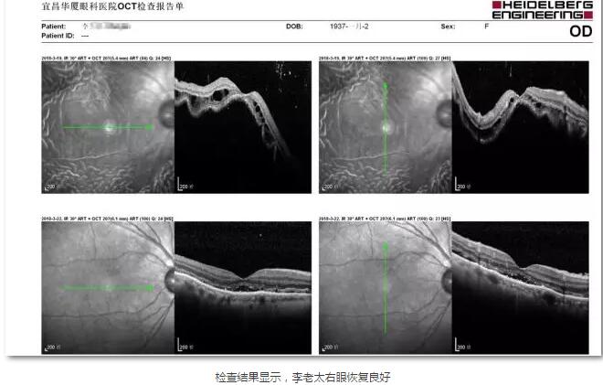 李老太在毫无征兆的情况下右眼视力下降至看不见东西。李老太家人带其至县医院就诊。医生诊断为视网膜脱离，需做玻切手术医治，而玻切手术需要动手术2次。怕疼的李老太一听就犯怵了：开刀，疼。 终，李老太的家人在多方打听后决定带李老太至宜昌8868体育官方网站(官方)登录入口找许大玲院长医治4.jpg