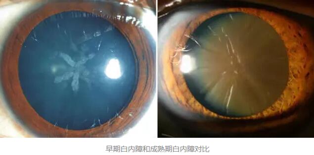 白内障超声乳化术是如今新式微创白内障手术，它创伤小、愈合快，术后 二天 正常生活。老年人能不能承受得住白内障手术呢2.jpg