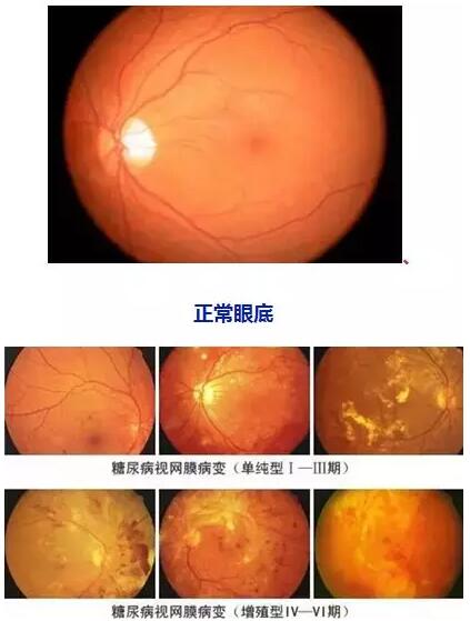 4月14日(本周六)福州眼科医院将举办“常见老年人眼底病”公益讲座，由医院副院长、眼底病科何建忠主任主讲，为大家解读各类眼底疾病的预防和诊治知识1.jpg