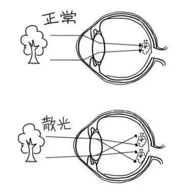 近视加散光想要 ，飞秒全激光近视手术是很好的选择。 一*次近视激光手术，就可以同时 近视、合并散光。1.jpg