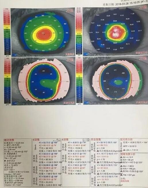角膜移植是利用异体的正常透明角膜组织，取代浑浊病变的角膜组织，使患者复明或控制角膜病变，这在目前同种器官移植当中， 率是 高的，也是重要的复明手术之一。”在 为一位饱受圆锥角膜之苦患者 实施角膜移植之后，卢敏院长也对患者极为关心的角膜移植相关知识进行介绍。比如哪些患者适合角膜移植手术
