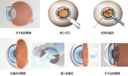 三焦点人工晶体手术原理：置换掉人眼老去的晶体，世代的晶体不仅有非常好的弹性，以往传统的白内障手术只是单纯的脱盲复明手术，更多的是解决患者 远视力。而三焦点人工晶体的问世，彻*解决了传统白内障术后仍需配镜的问题，实现了从以往‘看得见’到‘看得清、看得好’的转变.jpg