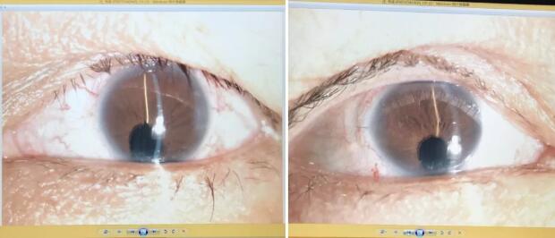 先天性虹膜脉络膜缺损的白内障患者在厦门眼科中心白内障超乳手术后视觉满意2.jpg