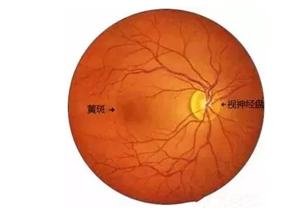 老年黄斑变性其实是眼部黄斑区结构的衰老性改变引起的眼病。“黄斑”是位于视网膜核心区的一个生理结构，一旦黄斑区的视神经细胞被破坏，就会引起患者中心视力下降、视物变形、色暗等1.png