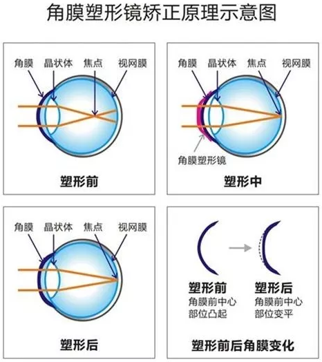 角膜塑形镜是一种硬性透气性隐形眼镜，戴在眼表可使角膜发生塑形效应，从而达到 近视度数的 。适合夜晚睡觉时配戴，白天不用戴眼镜就可以 裸眼视力，不影响学习、运动.png