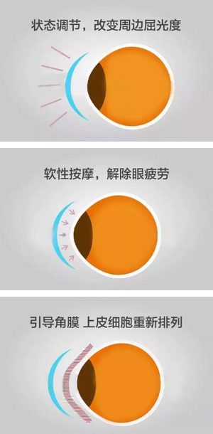 角膜塑形镜是一种硬性透气性隐形眼镜，戴在眼表可使角膜发生塑形效应，从而达到 近视度数的 。适合夜晚睡觉时配戴，白天不用戴眼镜就可以 裸眼视力，不影响学习、运动2.png