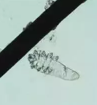 眼部瘙痒、干涩泛红、异物感，可能不是干眼症而是蠕形螨性睑缘炎.png