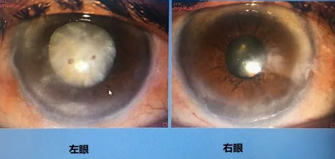 同时患 青光眼、白内障老婆婆辗转几家医院之后终于在成都8868体育网站登录入口顺利手术2.png