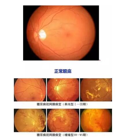 因糖网病几近失明在福州眼科医院进行微创玻切、白内障超乳术后顺利复明2.jpg