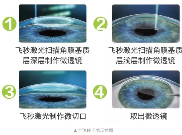 主流近视手术包含全飞秒激光手术、Smart全激光手术、半飞秒激光手术、晶体植入手术1.jpg