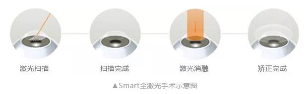 主流近视手术包含全飞秒激光手术、Smart全激光手术、半飞秒激光手术、晶体植入手术2.jpg