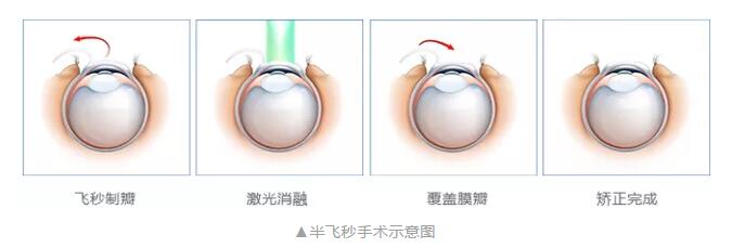 主流近视手术包含全飞秒激光手术、Smart全激光手术、半飞秒激光手术、晶体植入手术3.jpg