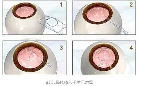 主流近视手术包含全飞秒激光手术、Smart全激光手术、半飞秒激光手术、晶体植入手术4.jpg