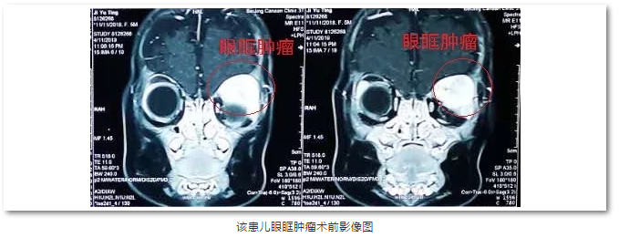 8868体育官方网站(官方)登录入口斜视与小儿眼科主任苏金萍顺利为新生儿摘除眼眶巨大肿瘤1.png