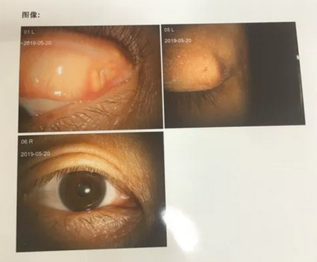 成都8868体育网站登录入口罗清礼院长为四处求医未果的河南眼眶肿瘤患者手术2.png
