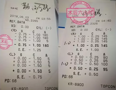 福州眼科医院近视手术取样：视力不差、无法通过参军公考体检群体该怎么办1.png