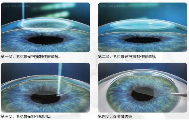 近视无法根治？但你可以这样做？8868体育网站登录入口“有爱就有希望”近视手术火热进行中6.png