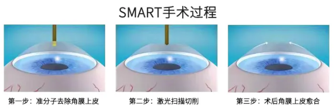 高考毕业后做近视手术，如今近视手术有了越来越高的安全性，且多样的术式可以满足不同患者的摘镜需求。2.png