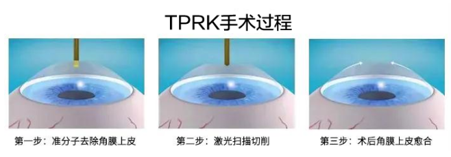 2021年征兵时间已定，参加征兵近视青年需尽快做近视手术3.png